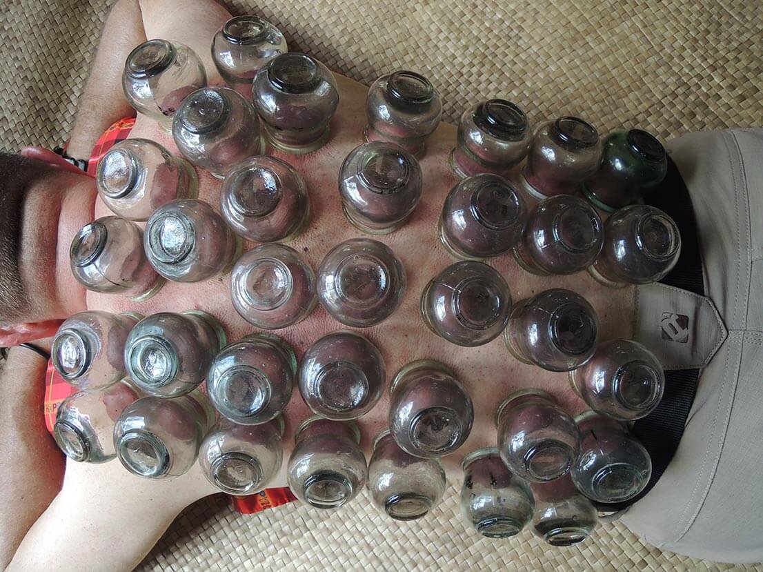 Cupping